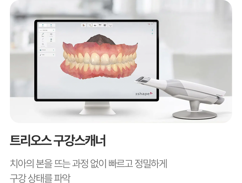 트리오스 구강스캐너 치아의 본을 뜨는 과정 없이 빠르고 정밀하게 구강 상태를 파악