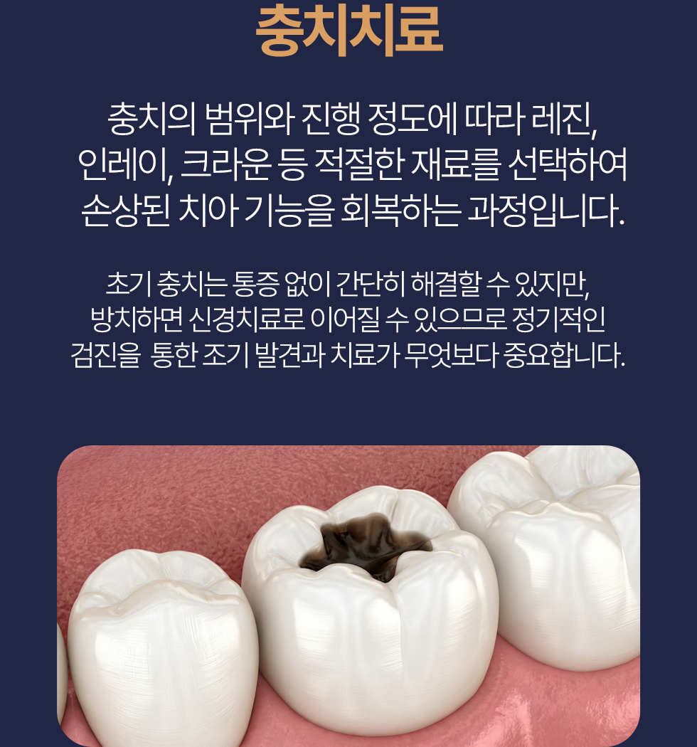 충치치료 충치의 범위와 진행 정도에 따라 레진, 인레이, 크라운 등 최적의 재료를 선택하여 손상된 치아 기능을 회복하는 과정입니다. 초기 충치는 통증 없이 간단히 해결할 수 있지만, 방치하면 신경치료로 이어질 수 있으므로 정기적인 검진을 통한 조기 발견과 치료가 무엇보다 중요합니다.