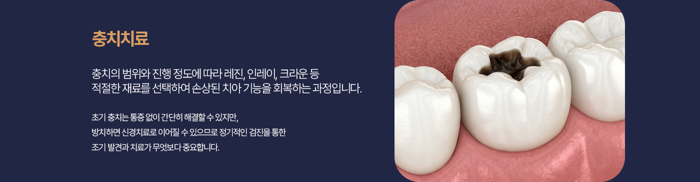 충치치료 충치의 범위와 진행 정도에 따라 레진, 인레이, 크라운 등 최적의 재료를 선택하여 손상된 치아 기능을 회복하는 과정입니다. 초기 충치는 통증 없이 간단히 해결할 수 있지만, 방치하면 신경치료로 이어질 수 있으므로 정기적인 검진을 통한 조기 발견과 치료가 무엇보다 중요합니다.