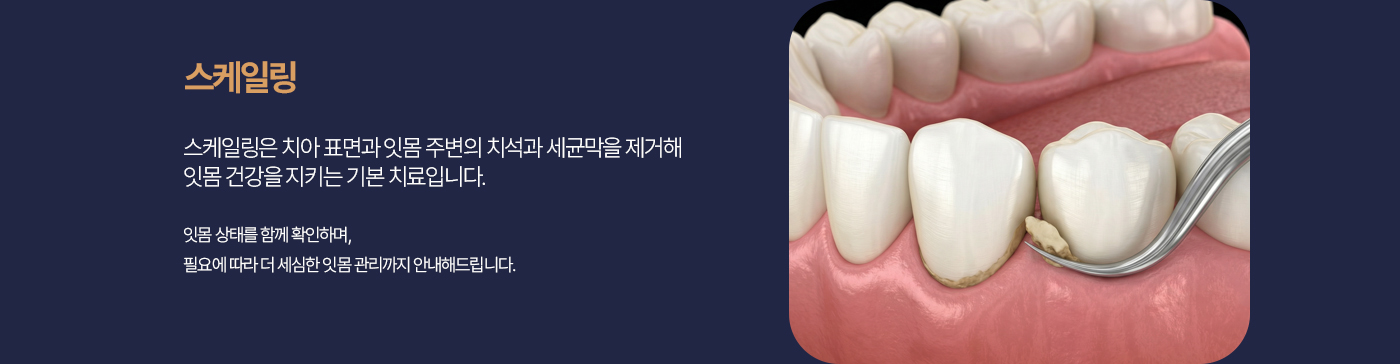 스케일링 스케일링은 치아 표면과 잇몸 주변의 치석과 세균막을 제거해 잇몸 건강을 지키는 기본 치료입니다. 잇몸 상태를 함께 확인하며, 필요에 따라 더 세심한 잇몸 관리까지 안내해드립니다.